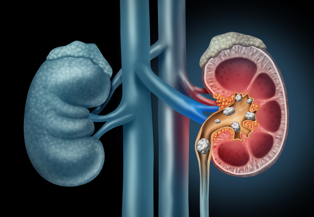 3d illustration of kidney stones